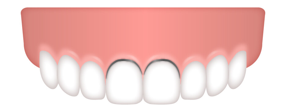 歯と歯ぐきの間から金属が露出「ブラックマージン」