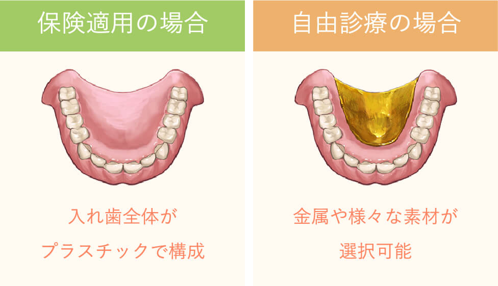 保険適用の場合入れ歯全体がプラスチックで構成自由診療の場合金属や様々な素材が選択可能