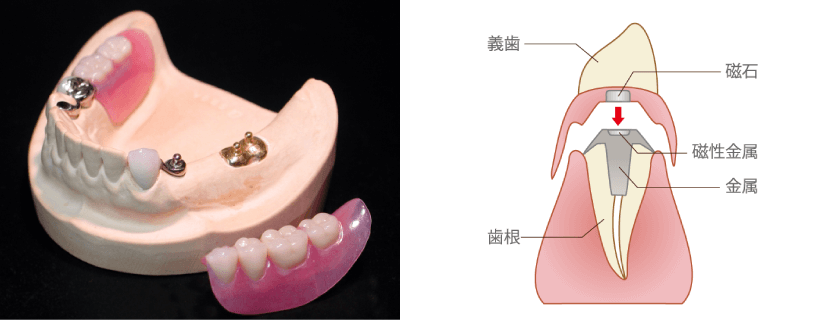 アタッチメント義歯・マグネット式義歯