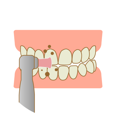 歯のクリーニングとホワイトニングキットの説明